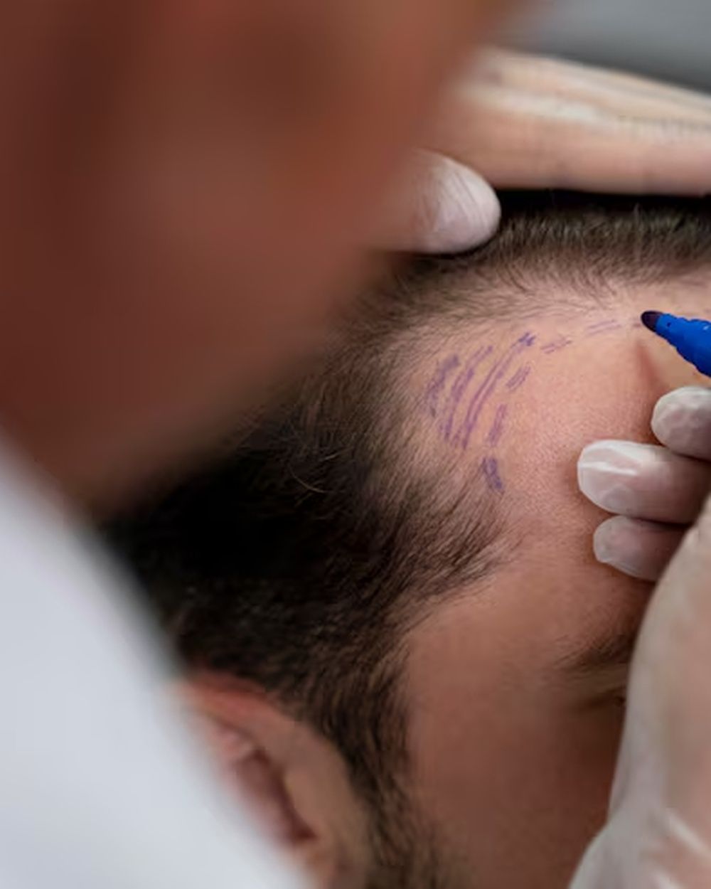 Before scalp micropigmentation: receding hairline and thinning crown
